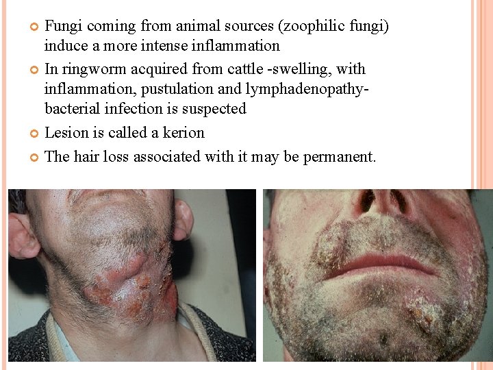 Fungi coming from animal sources (zoophilic fungi) induce a more intense inflammation In ringworm