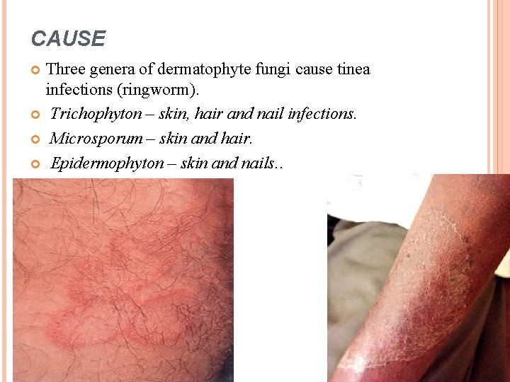 CAUSE Three genera of dermatophyte fungi cause tinea infections (ringworm). Trichophyton – skin, hair