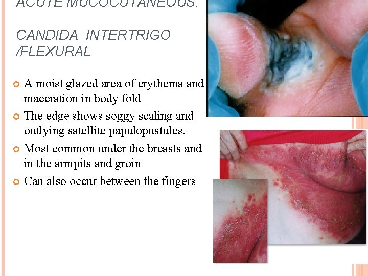 ACUTE MUCOCUTANEOUS: CANDIDA INTERTRIGO /FLEXURAL A moist glazed area of erythema and maceration in