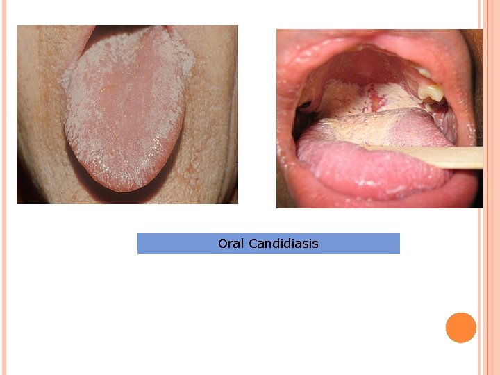 Oral Candidiasis 