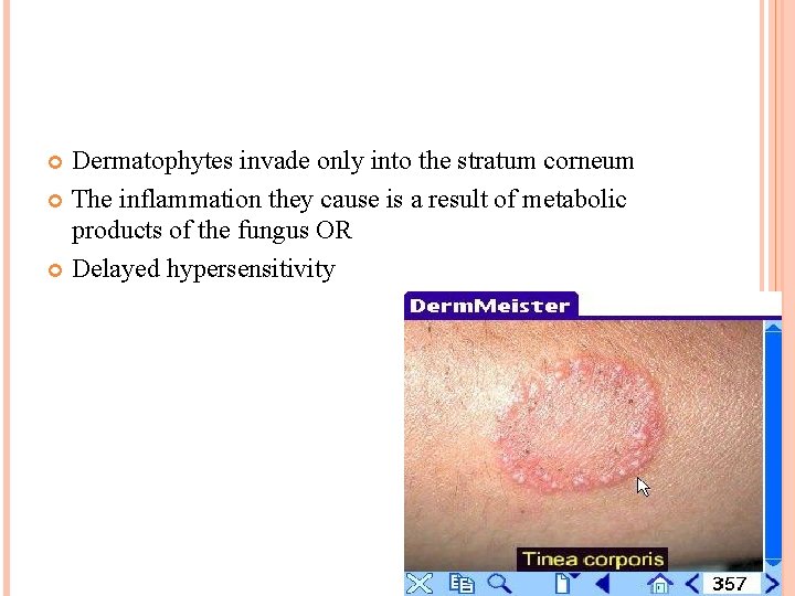 Dermatophytes invade only into the stratum corneum The inflammation they cause is a result