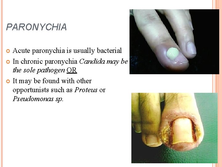 PARONYCHIA Acute paronychia is usually bacterial In chronic paronychia Candida may be the sole