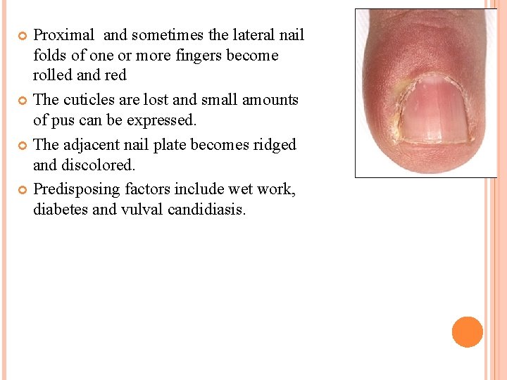 Proximal and sometimes the lateral nail folds of one or more fingers become rolled