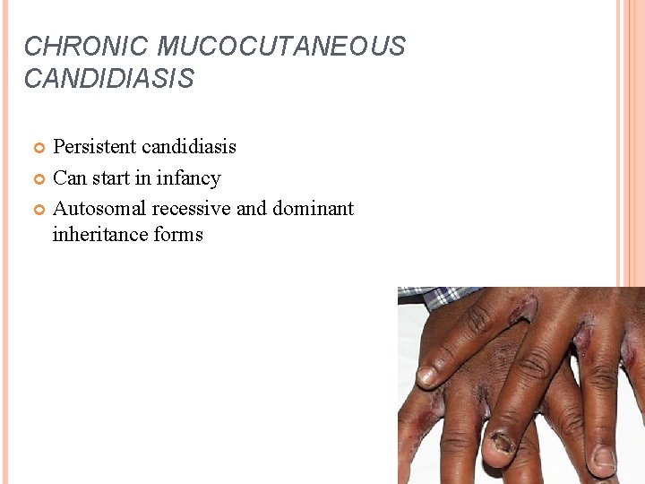 CHRONIC MUCOCUTANEOUS CANDIDIASIS Persistent candidiasis Can start in infancy Autosomal recessive and dominant inheritance