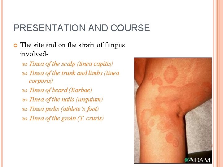 PRESENTATION AND COURSE The site and on the strain of fungus involved Tinea of