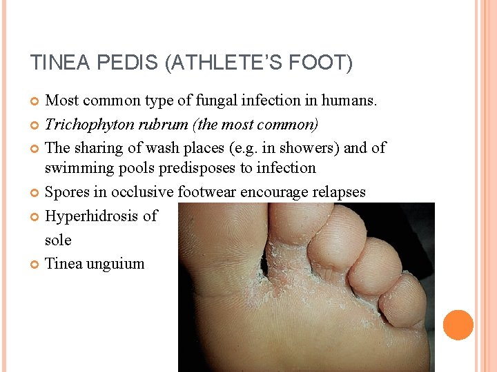 TINEA PEDIS (ATHLETE’S FOOT) Most common type of fungal infection in humans. Trichophyton rubrum