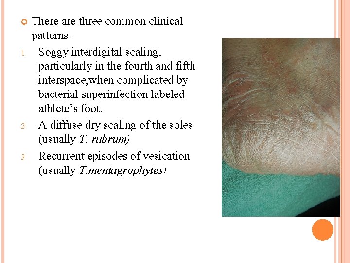  1. 2. 3. There are three common clinical patterns. Soggy interdigital scaling, particularly