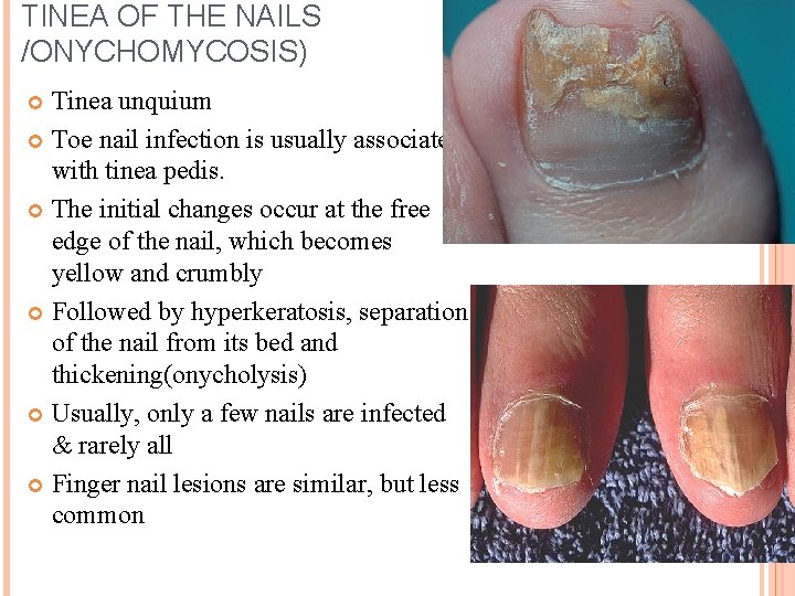 TINEA OF THE NAILS /ONYCHOMYCOSIS) Tinea unquium Toe nail infection is usually associated with