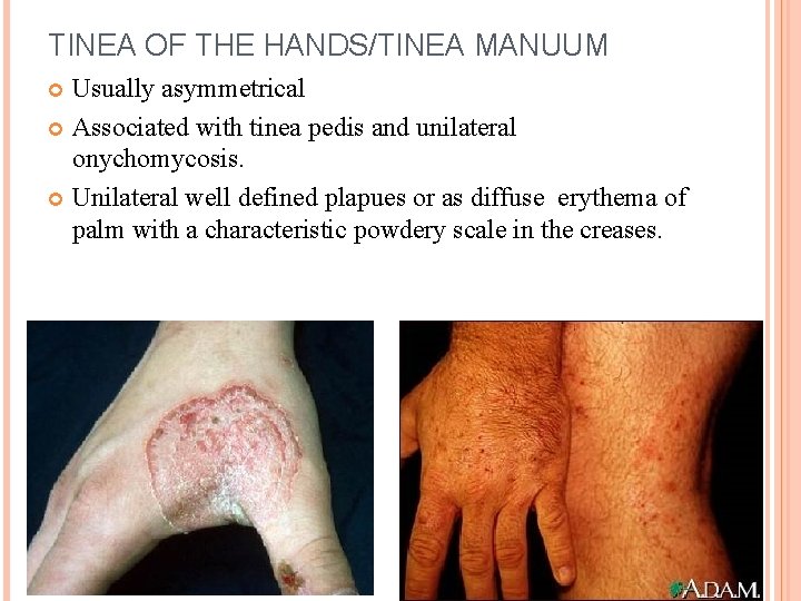 TINEA OF THE HANDS/TINEA MANUUM Usually asymmetrical Associated with tinea pedis and unilateral onychomycosis.