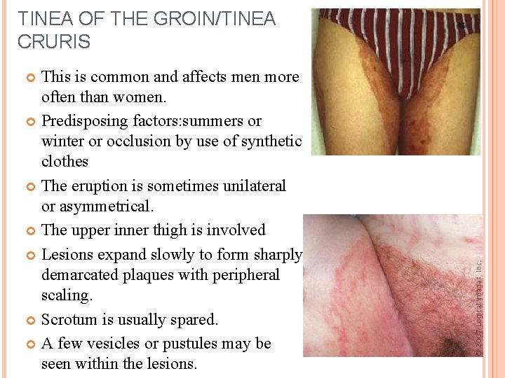 TINEA OF THE GROIN/TINEA CRURIS This is common and affects men more often than