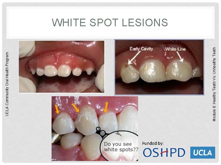 Module 8: Healthy Teeth Vs. Unhealthy Teeth UCLA Community Oral Health Program WHITE SPOT