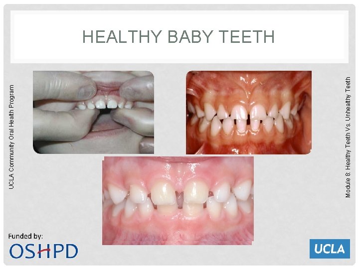 Module 8: Healthy Teeth Vs. Unhealthy Teeth UCLA Community Oral Health Program HEALTHY BABY