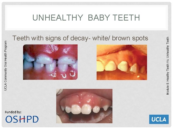 UCLA Community Oral Health Program Teeth with signs of decay- white/ brown spots Module