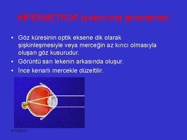 HİPERMETROP (yakını net görememe) • Göz küresinin optik eksene dik olarak şişkinleşmesiyle veya merceğin