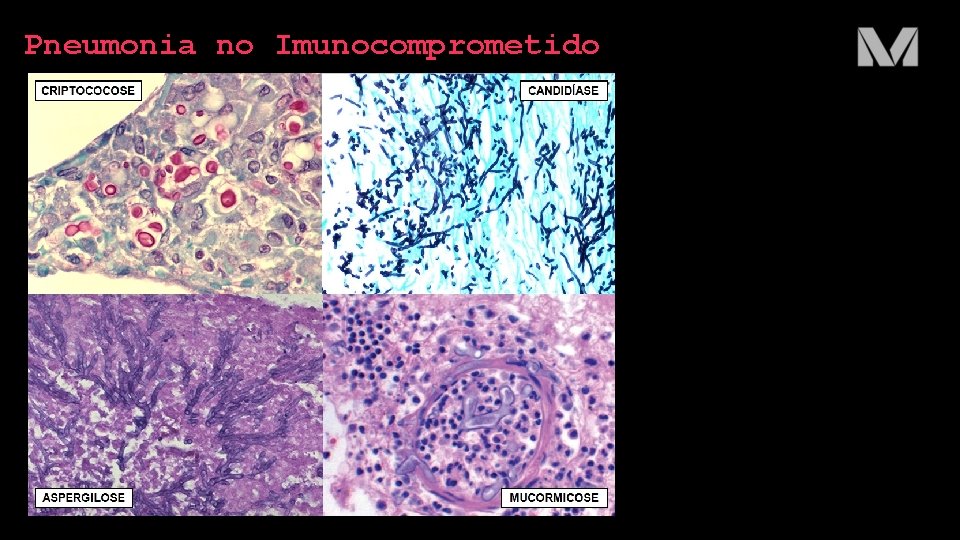 Pneumonia no Imunocomprometido 