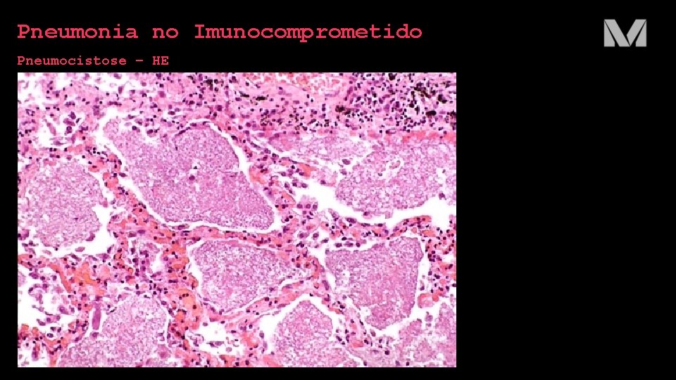 Pneumonia no Imunocomprometido Pneumocistose – HE 