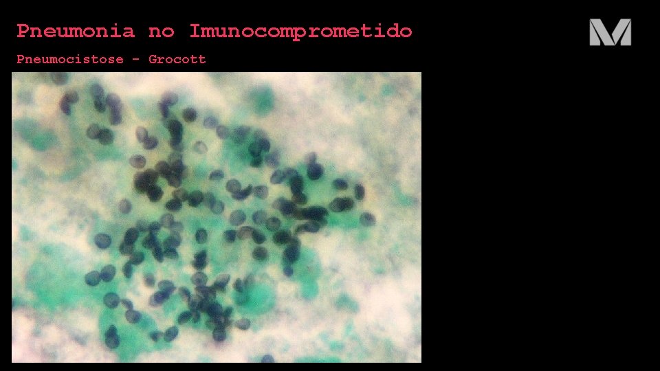 Pneumonia no Imunocomprometido Pneumocistose - Grocott 