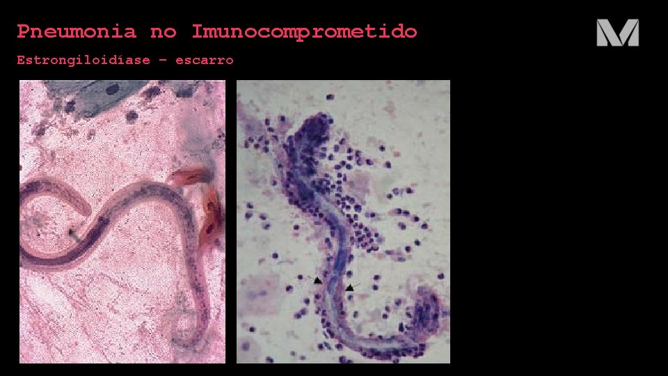 Pneumonia no Imunocomprometido Estrongiloidíase – escarro 