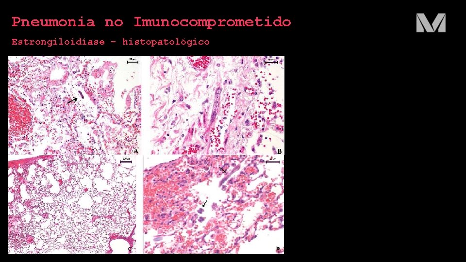 Pneumonia no Imunocomprometido Estrongiloidíase - histopatológico 