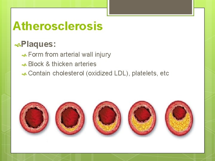 Atherosclerosis Plaques: Form from arterial wall injury Block & thicken arteries Contain cholesterol (oxidized Atherosclerosis Plaques: Form from arterial wall injury Block & thicken arteries Contain cholesterol (oxidized