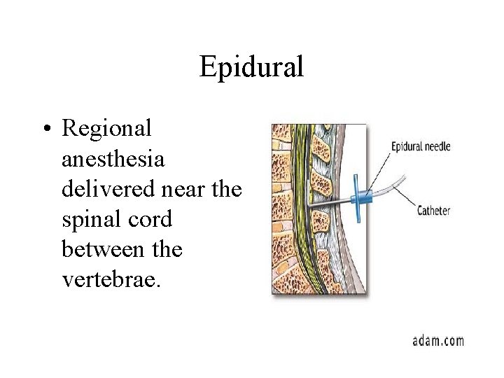 Epidural • Regional anesthesia delivered near the spinal cord between the vertebrae. 