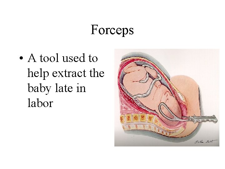 Forceps • A tool used to help extract the baby late in labor 