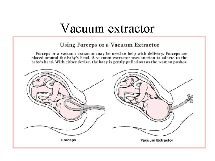 Vacuum extractor 