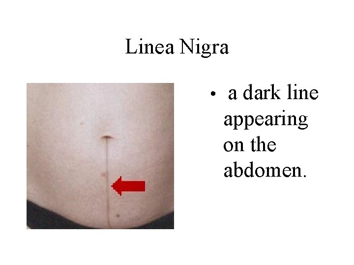 Linea Nigra • a dark line appearing on the abdomen. 