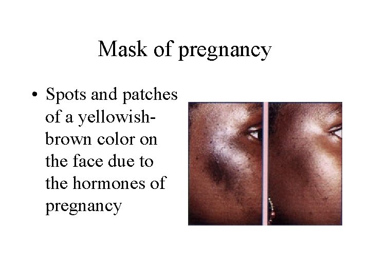 Mask of pregnancy • Spots and patches of a yellowishbrown color on the face