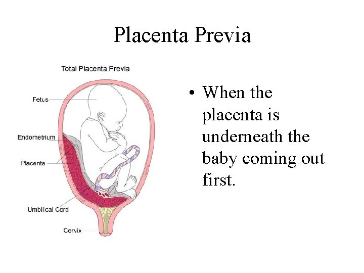 Placenta Previa • When the placenta is underneath the baby coming out first. 