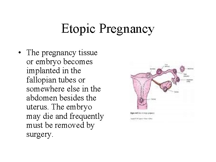 Etopic Pregnancy • The pregnancy tissue or embryo becomes implanted in the fallopian tubes