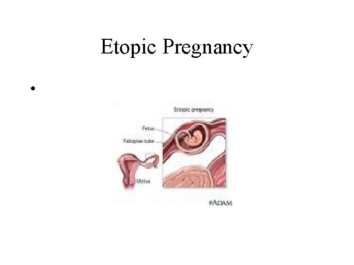 Etopic Pregnancy • 