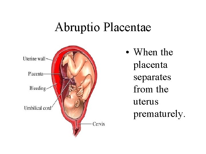 Abruptio Placentae • When the placenta separates from the uterus prematurely. 