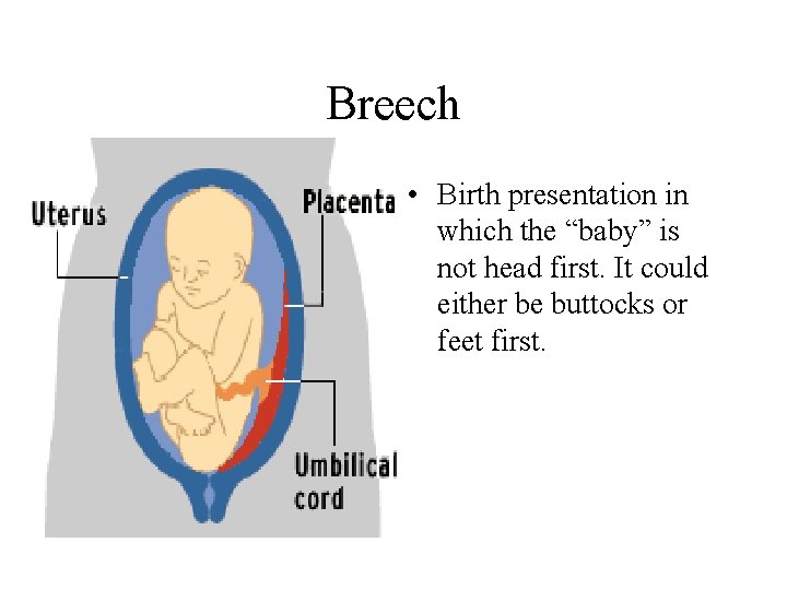 Breech • Birth presentation in which the “baby” is not head first. It could