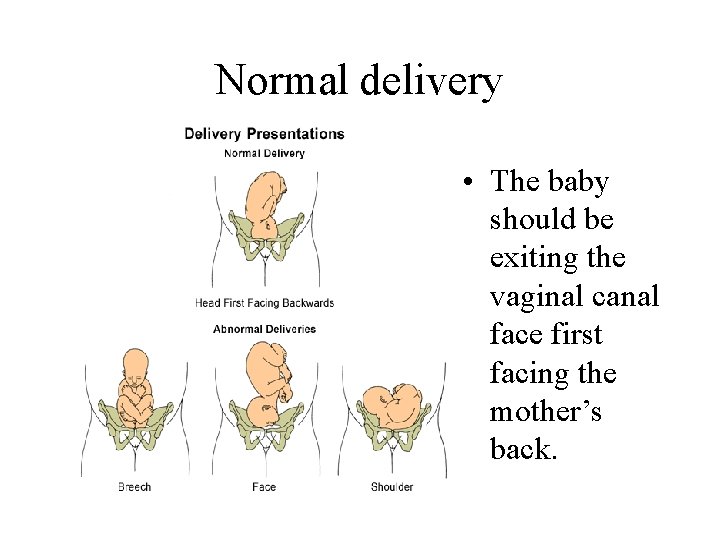 Normal delivery • The baby should be exiting the vaginal canal face first facing