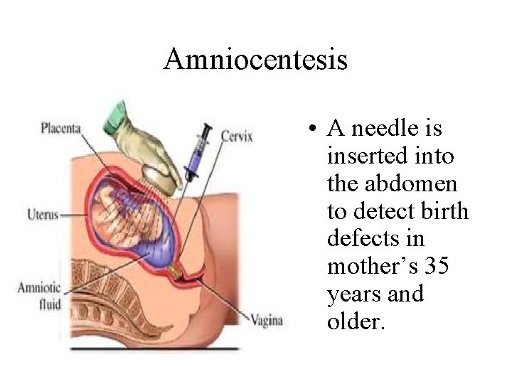 Amniocentesis • A needle is inserted into the abdomen to detect birth defects in