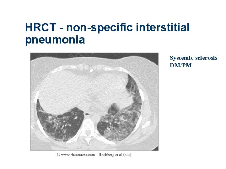 HRCT - non-specific interstitial pneumonia Systemic sclerosis DM/PM 