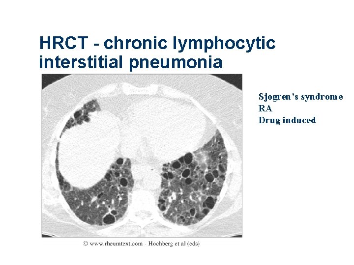 HRCT - chronic lymphocytic interstitial pneumonia Sjogren’s syndrome RA Drug induced 
