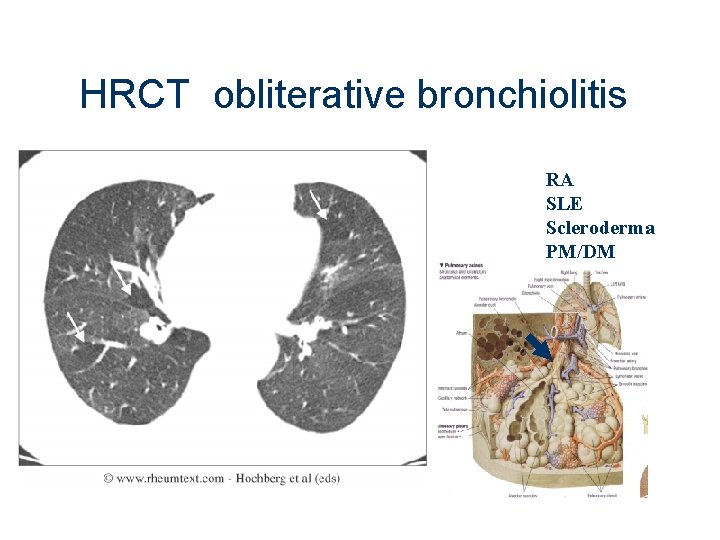 HRCT obliterative bronchiolitis RA SLE Scleroderma PM/DM 