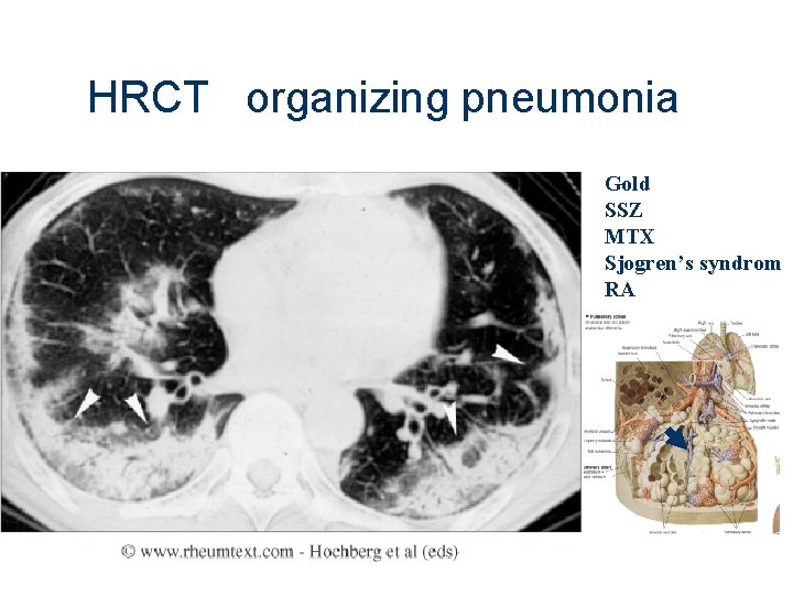 HRCT organizing pneumonia Gold SSZ MTX Sjogren’s syndrom RA 