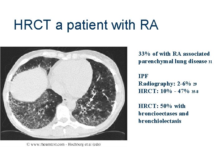 HRCT a patient with RA 33% of with RA associated parenchymal lung disease 31