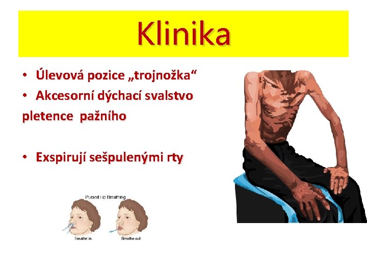 Klinika • Úlevová pozice „trojnožka“ • Akcesorní dýchací svalstvo pletence pažního • Exspirují sešpulenými