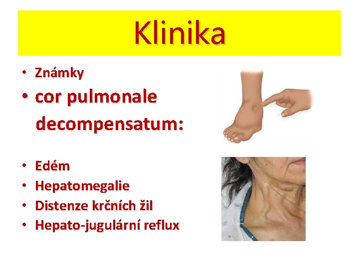 Klinika • Známky • cor pulmonale decompensatum: • • Edém Hepatomegalie Distenze krčních žil