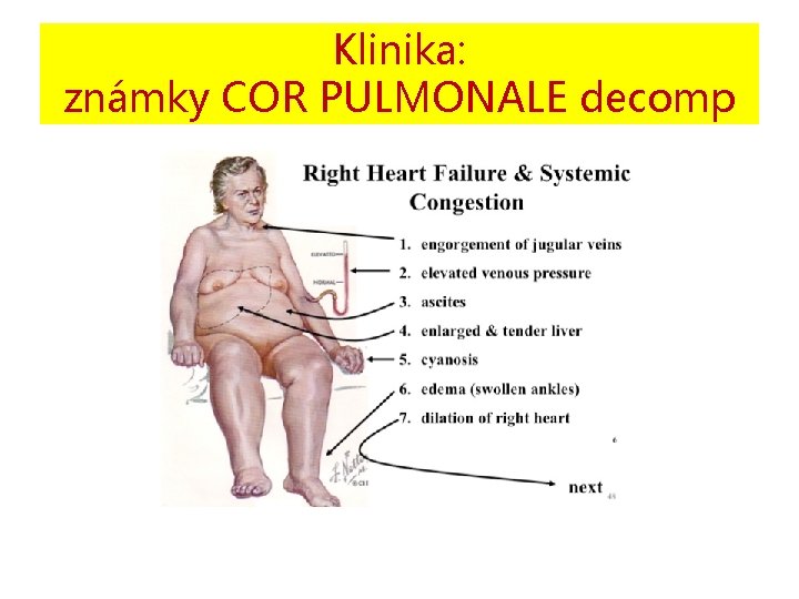 Klinika: známky COR PULMONALE decomp 