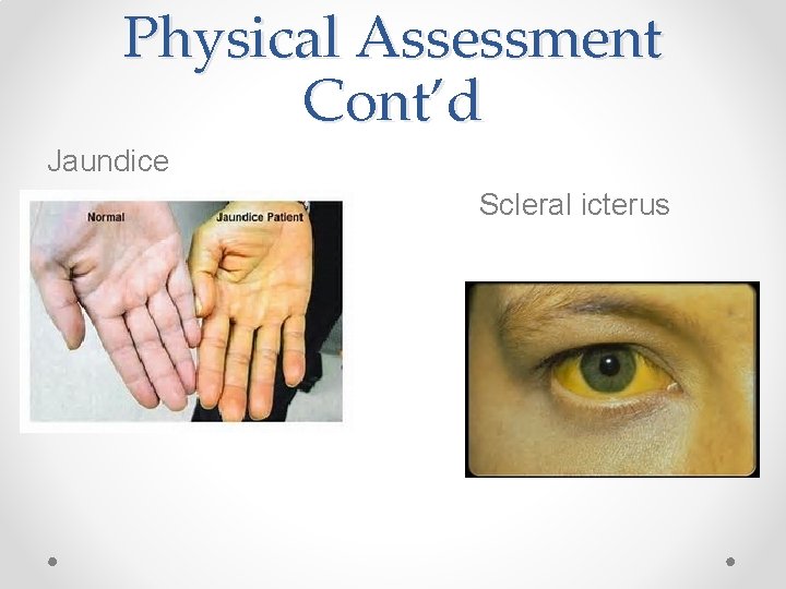 Physical Assessment Cont’d Jaundice Scleral icterus 