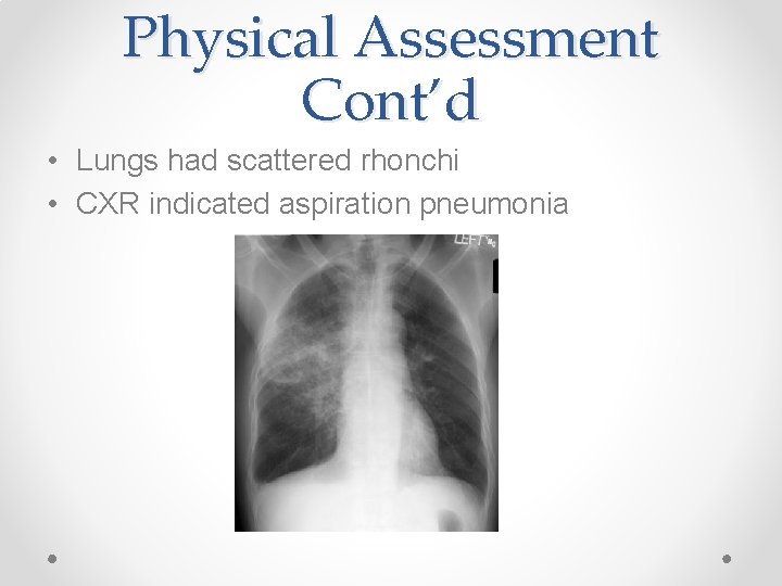 Physical Assessment Cont’d • Lungs had scattered rhonchi • CXR indicated aspiration pneumonia 