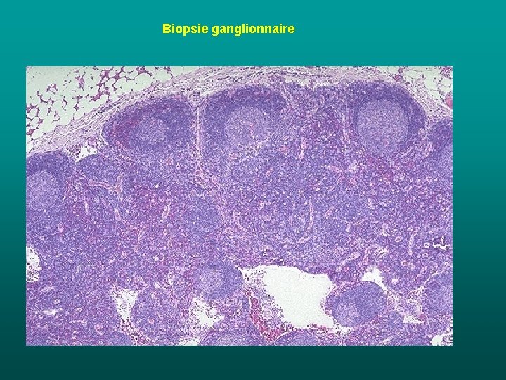 Biopsie ganglionnaire Biopsie ganglionnaire