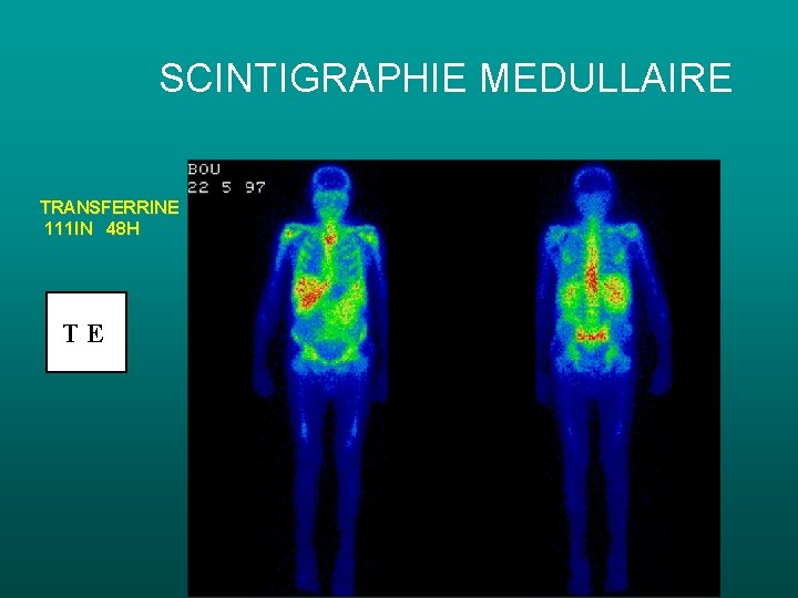 SCINTIGRAPHIE MEDULLAIRE TRANSFERRINE 111 IN 48 H TE SCINTIGRAPHIE MEDULLAIRE TRANSFERRINE 111 IN 48 H TE