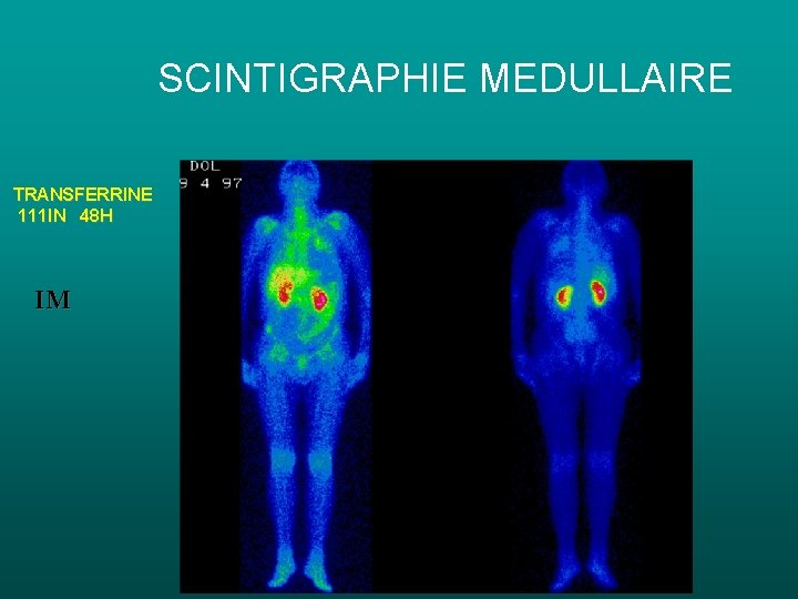 SCINTIGRAPHIE MEDULLAIRE TRANSFERRINE 111 IN 48 H IM SCINTIGRAPHIE MEDULLAIRE TRANSFERRINE 111 IN 48 H IM