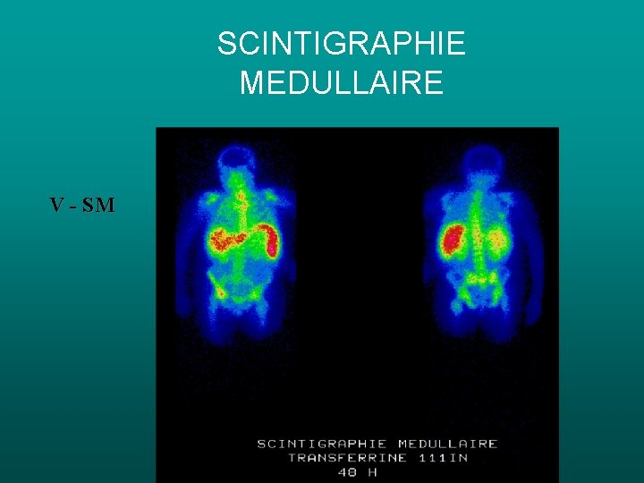 SCINTIGRAPHIE MEDULLAIRE V - SM SCINTIGRAPHIE MEDULLAIRE V - SM